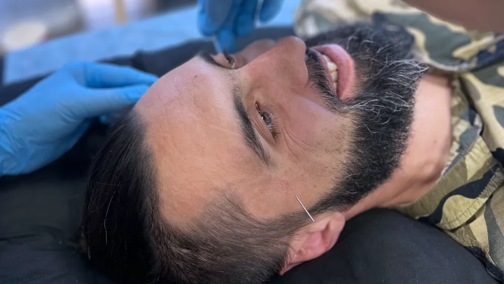 метод сухой иглы 2